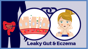 Is Leaky Gut Syndrome a possible root cause of Eczema? | Eczemaless
