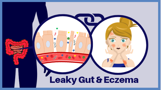 Is Leaky Gut Syndrome a possible root cause of Eczema?
