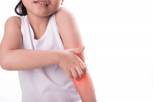 Child Eczema