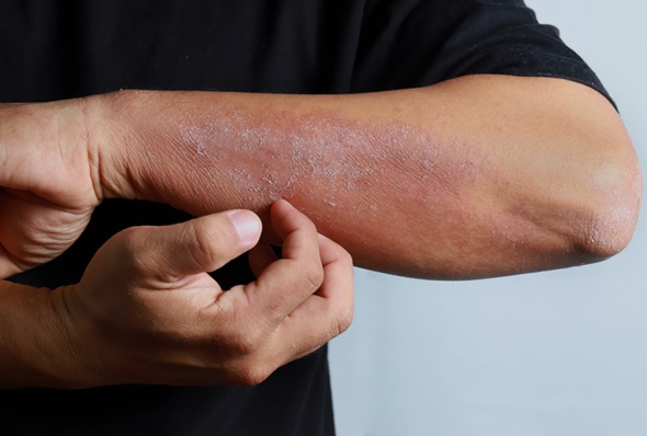 Things you should know to detect Eczema Infection