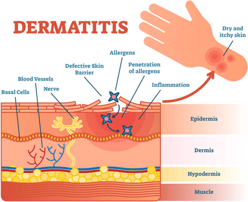 Atopic Dermatitis Scratching Damages the skin layer