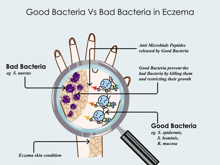 What is Microbiome Role in Eczema and its Treatment Eczemaless