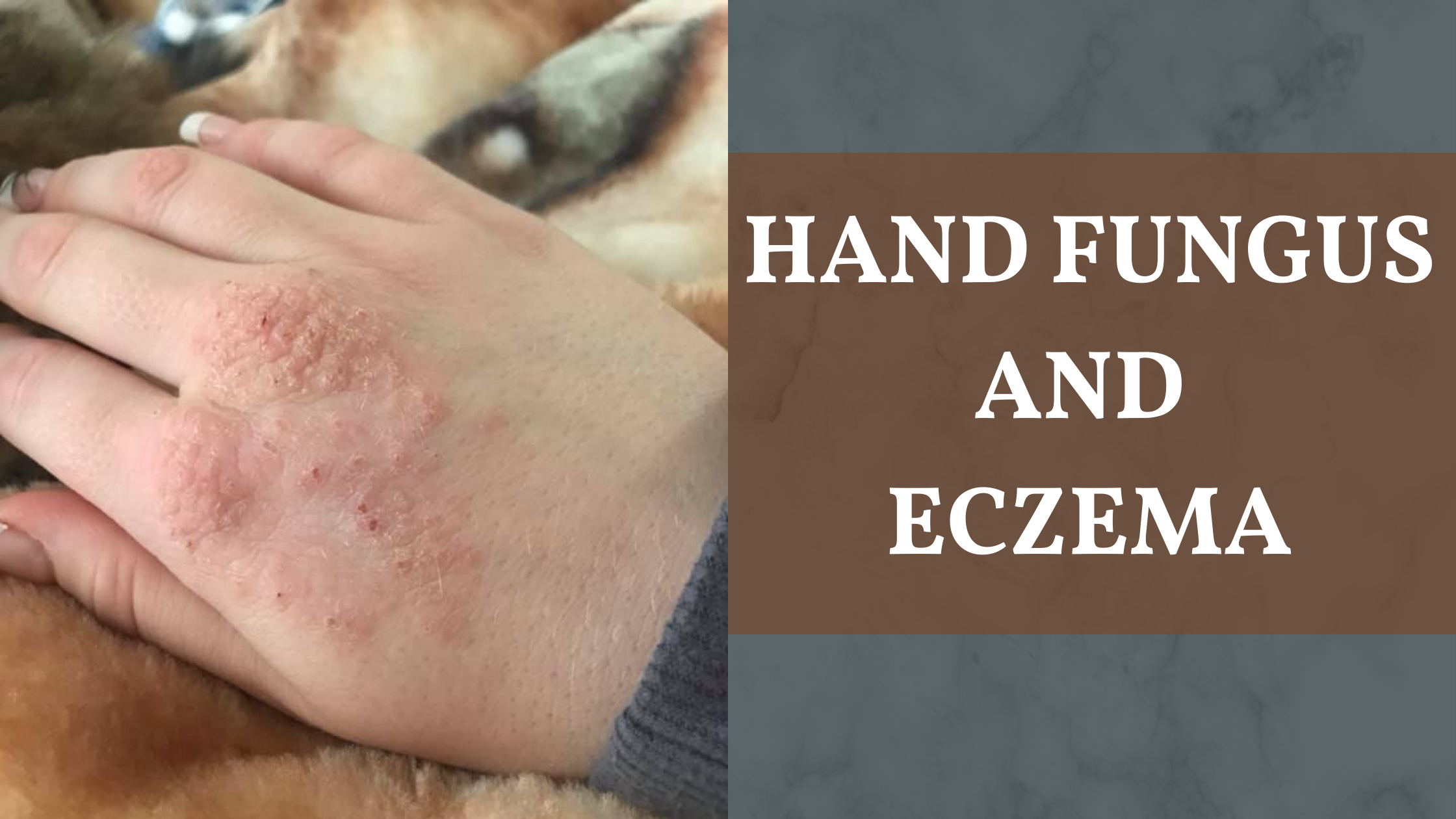Hand Eczema and Hand Fungus