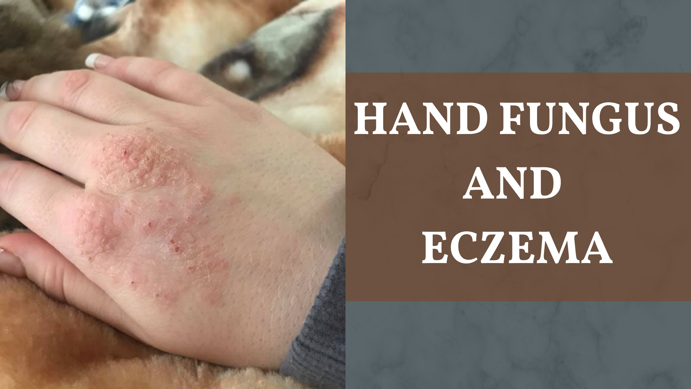 เชื้อราที่มือและโรคผิวหนังอักเสบ | Eczemaless