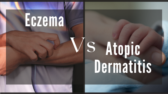 Eczema Vs Atopic Dermatitis