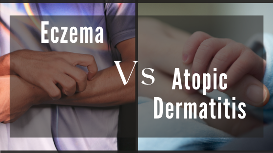 Eczema Vs Atopic Dermatitis Whats The Difference Eczema And Dermatitis 8831