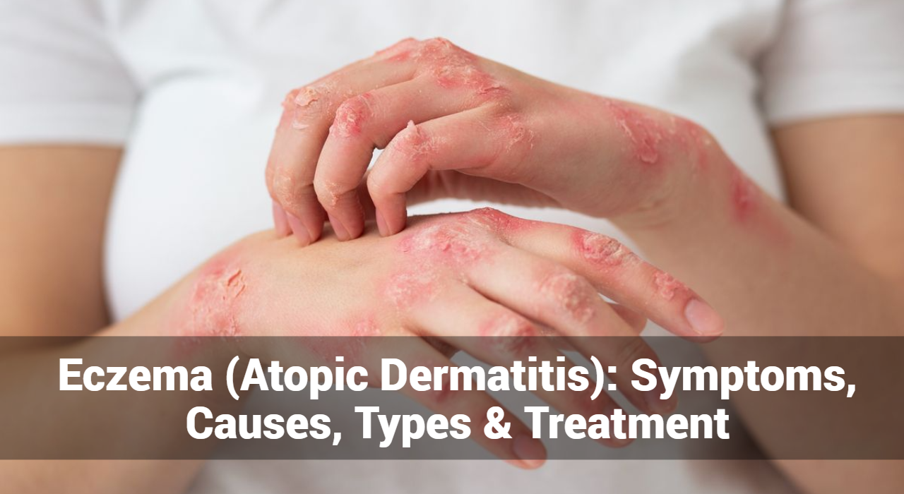 الأكزيما (التهاب الجلد التأتبي): الأعراض والأسباب والأنواع والعلاج