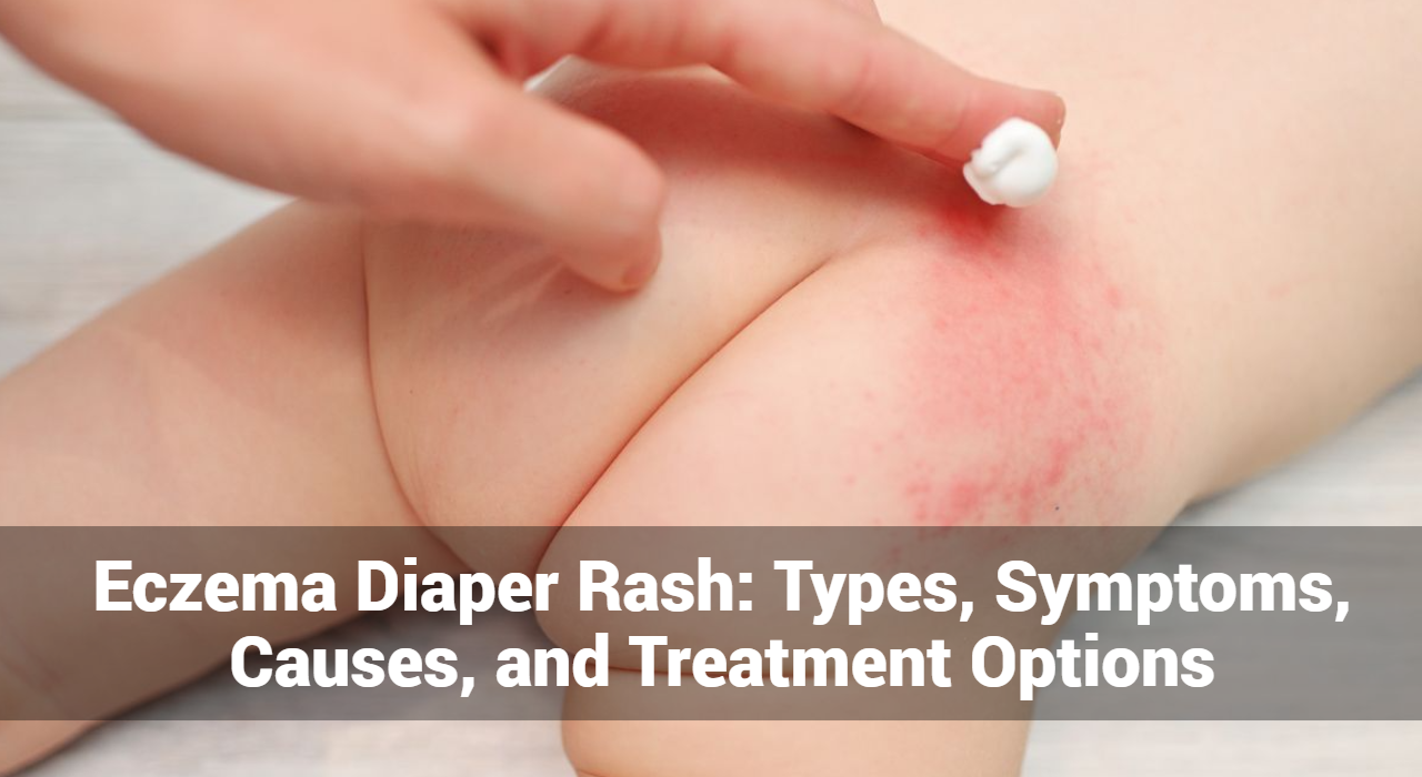 Eczema Diaper Rash: Types, Symptoms, Causes, and Treatment Options