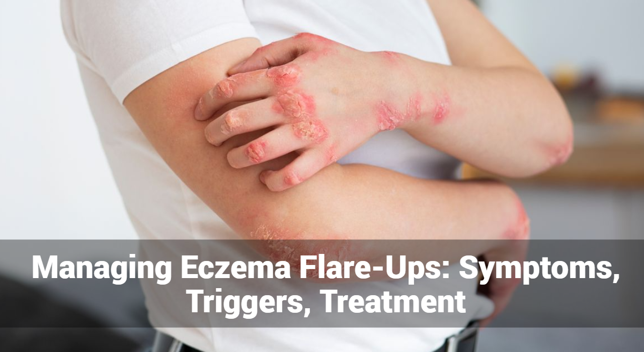 Managing Eczema Flare-Ups: Symptoms, Triggers, Treatment
