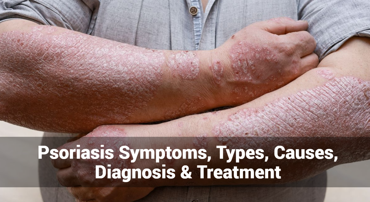 Symptômes, types, causes, diagnostic et traitement du psoriasis