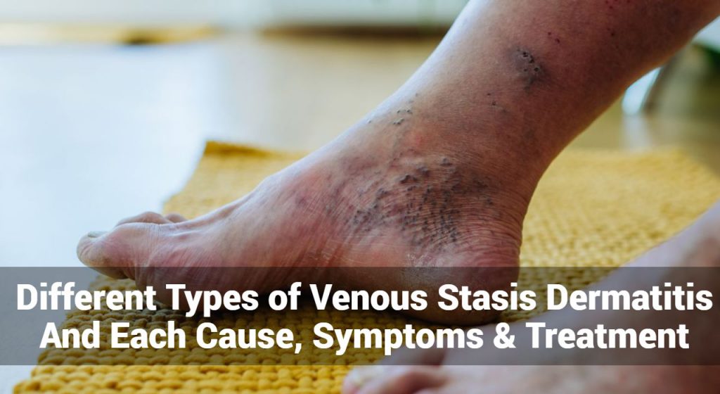 Different Types of Venous Stasis Dermatitis And Each Cause, Symptoms ...