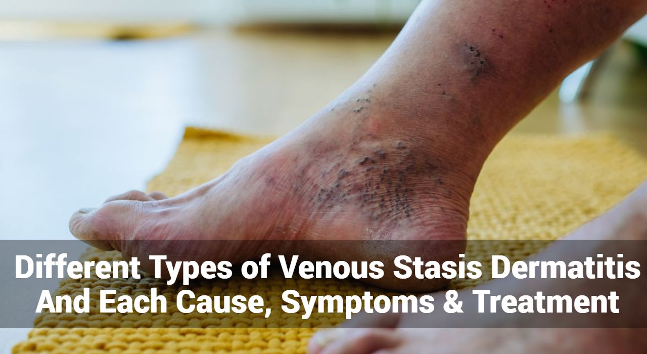 Diferentes tipos de dermatitis por estasis venosa y cada causa, síntomas y tratamiento