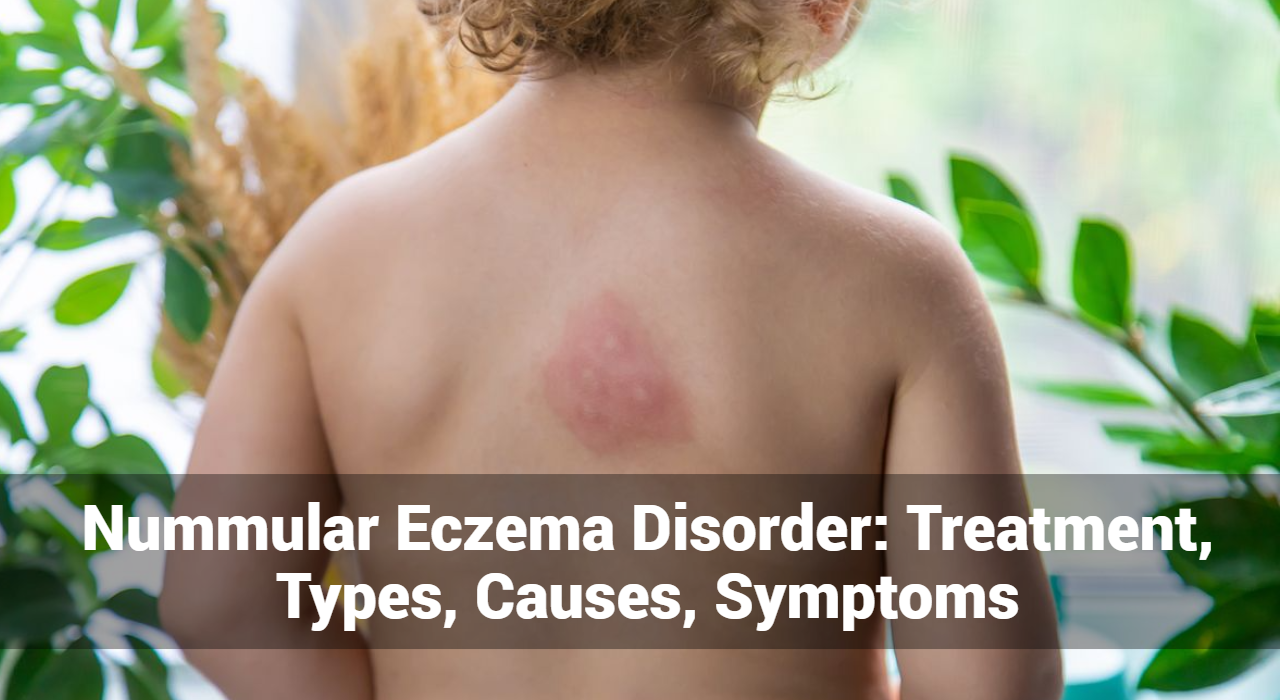 Nummulaire eczeemstoornis: behandeling, typen, oorzaken, symptomen
