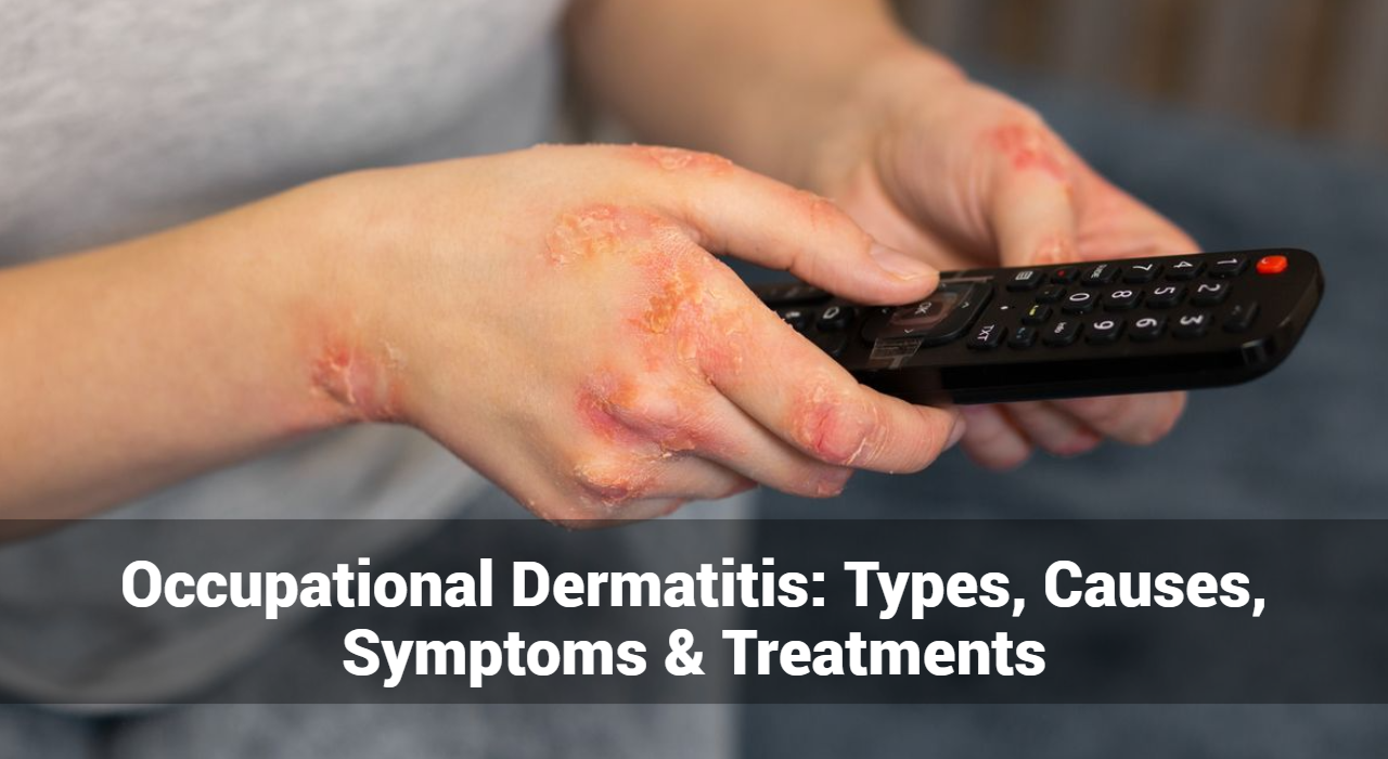 Dermatite professionnelle : types, causes, symptômes et traitements
