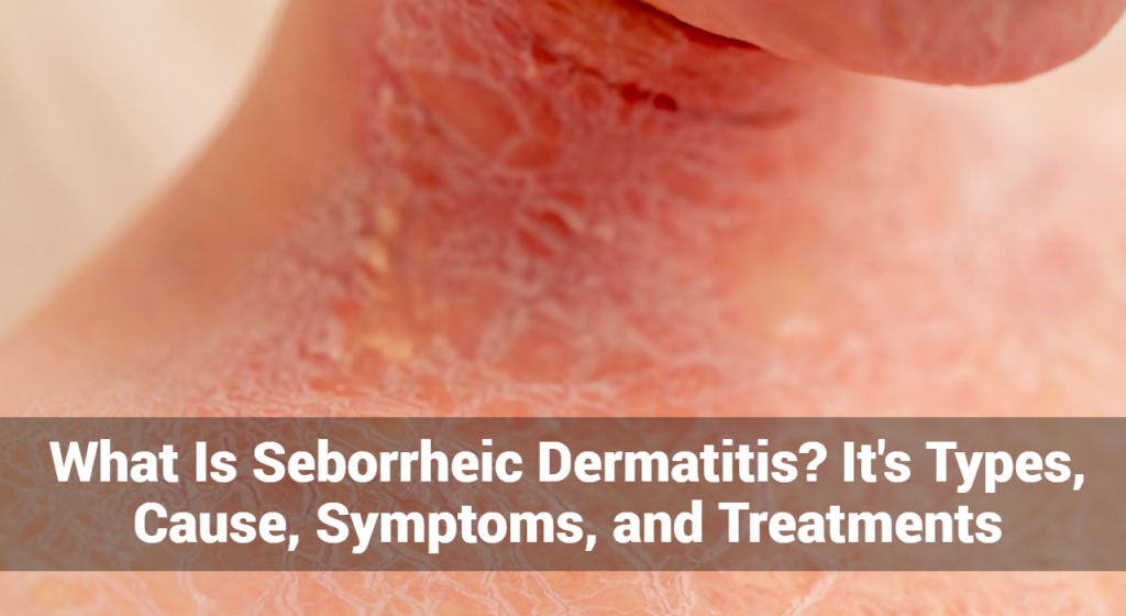 What Is Seborrheic Dermatitis Its Types Cause Symptoms And Treatments Eczemaless