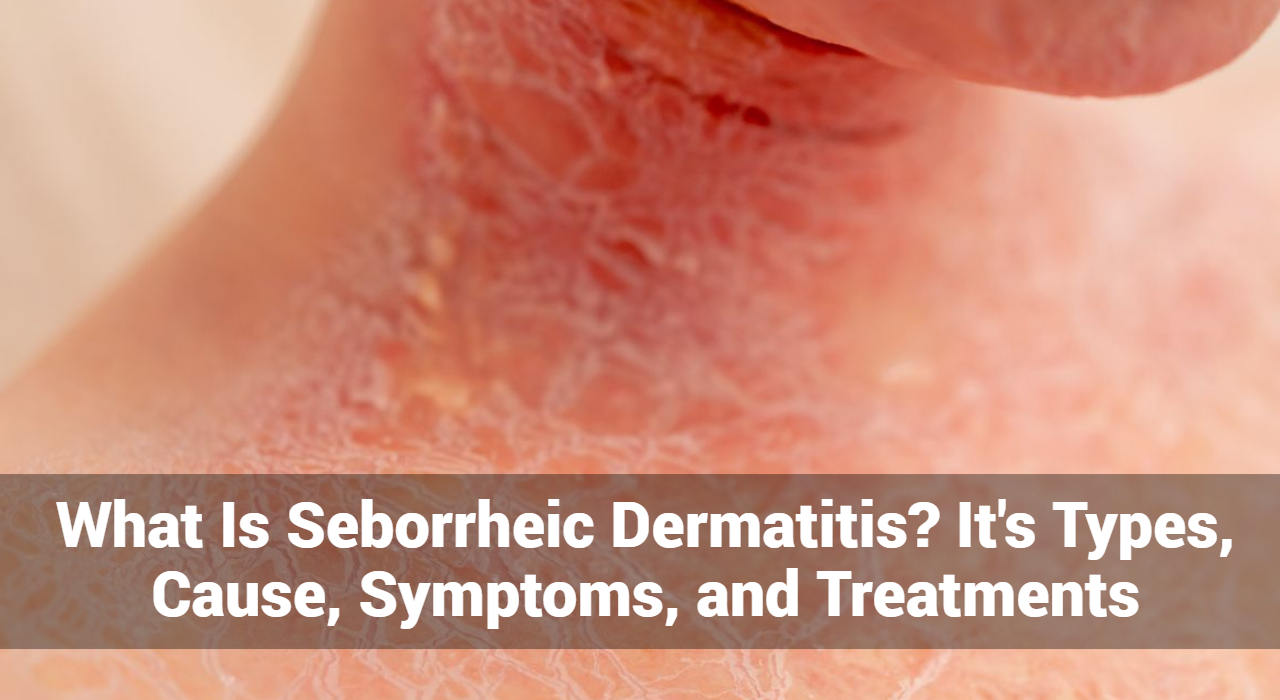 Wat is seborrheische dermatitis? Het zijn typen, oorzaken, symptomen en behandelingen