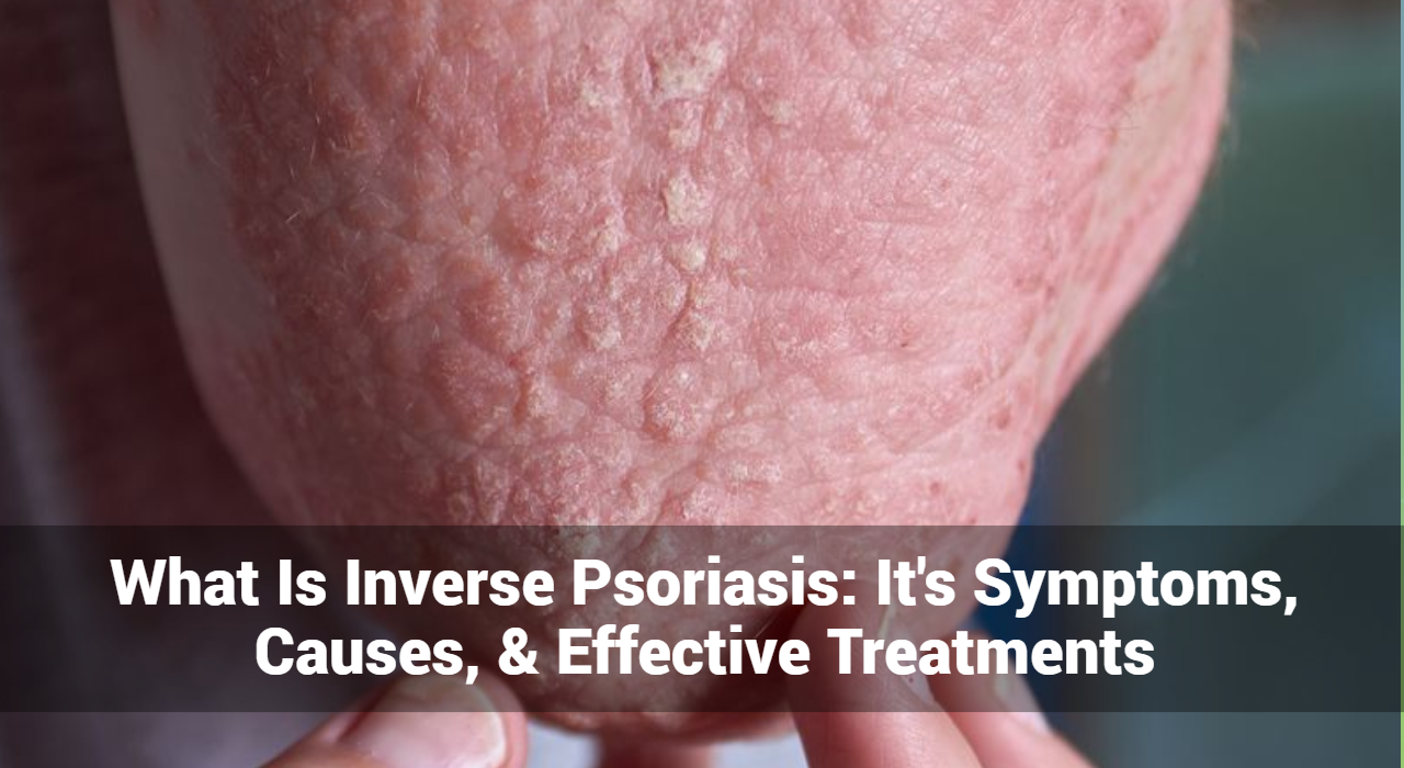 ¿Qué es la psoriasis inversa? Son síntomas, causas y tratamientos efectivos