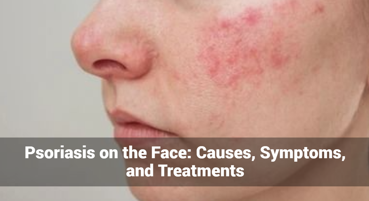 Psoriasis op het gezicht: oorzaken, symptomen en behandelingen