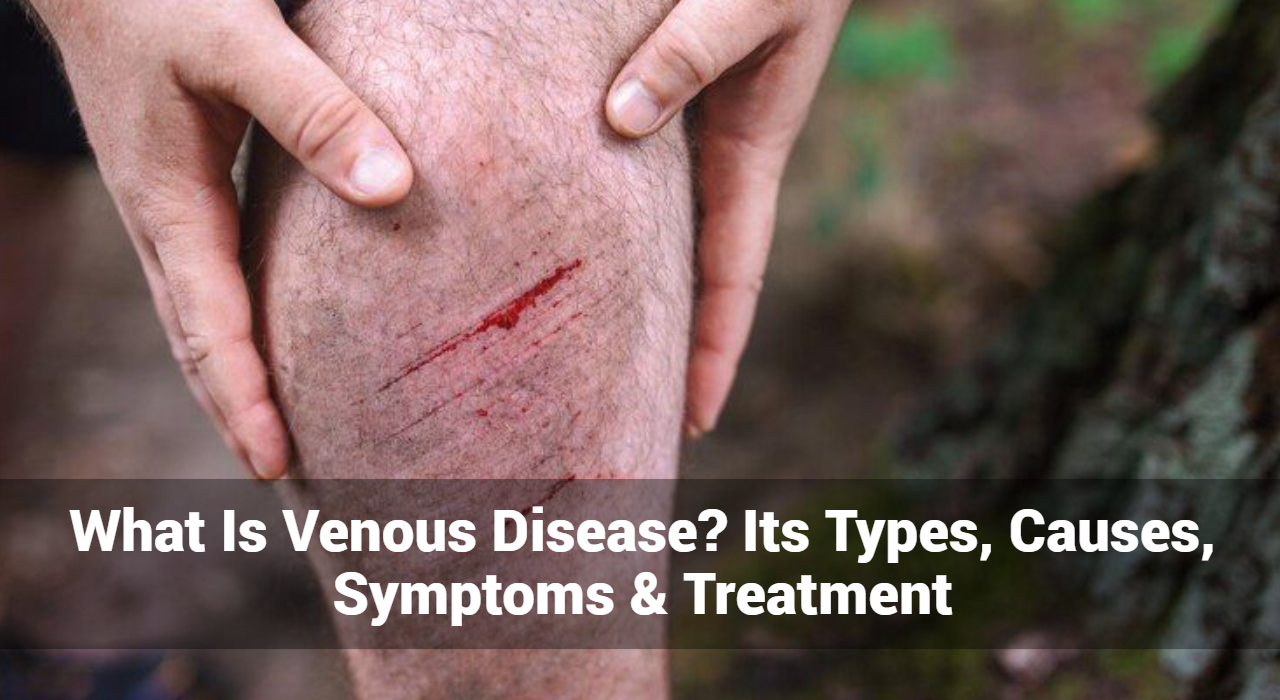 ¿Qué es la enfermedad venosa? Sus tipos, causas, síntomas y tratamiento.