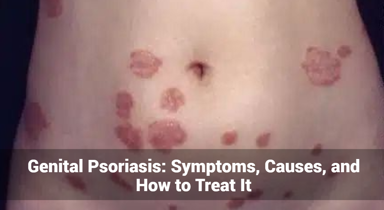 Psoriasis génital : symptômes, causes et comment le traiter