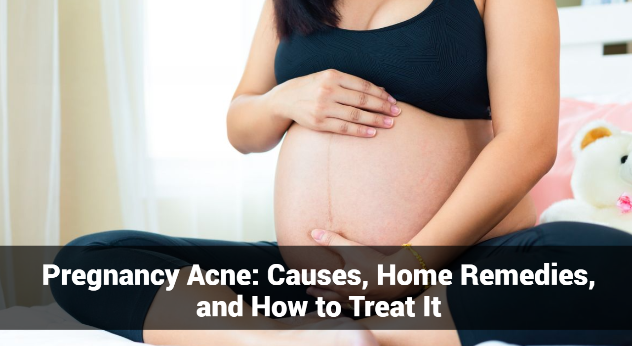 Pregnancy Acne: Causes, Home Remedies, and How to Treat It