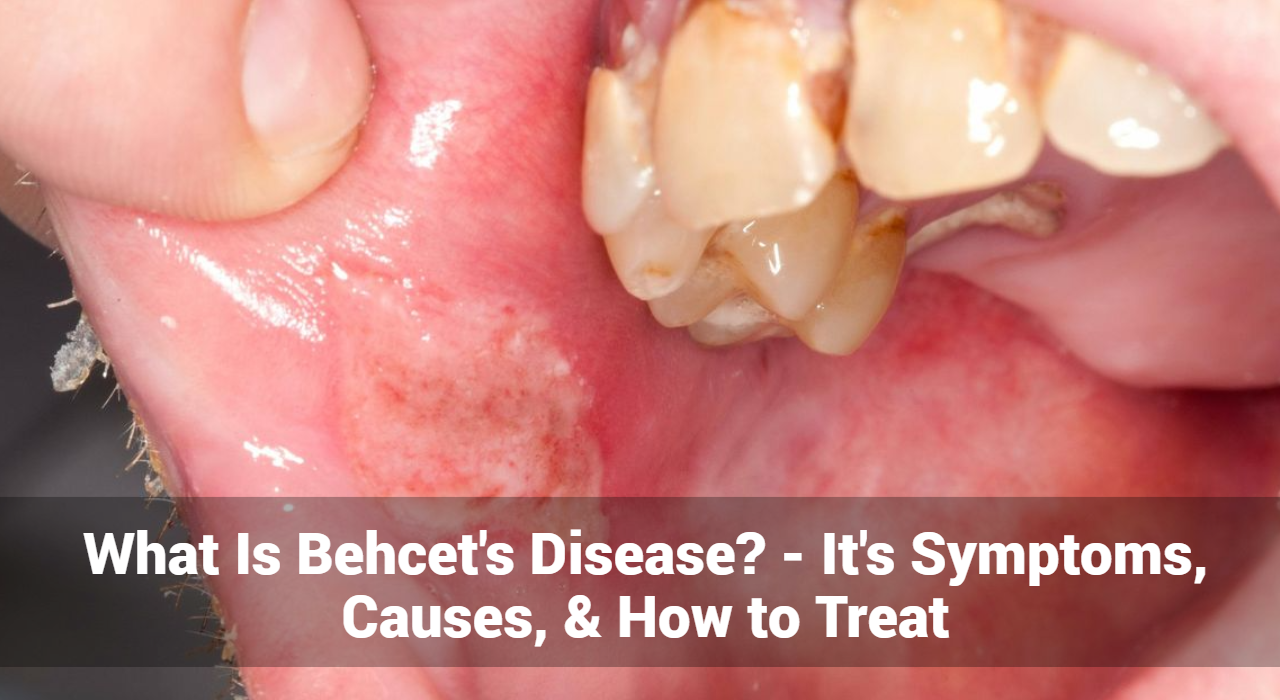What Is Behcet’s Disease? – It’s Symptoms, Causes, & How to Treat