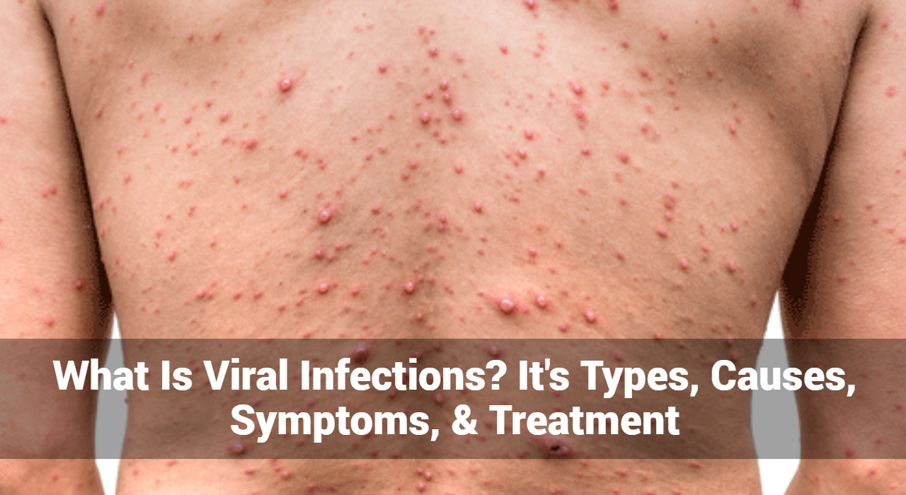 What Is Viral Infections? It’s Types, Causes, Symptoms, & Treatment