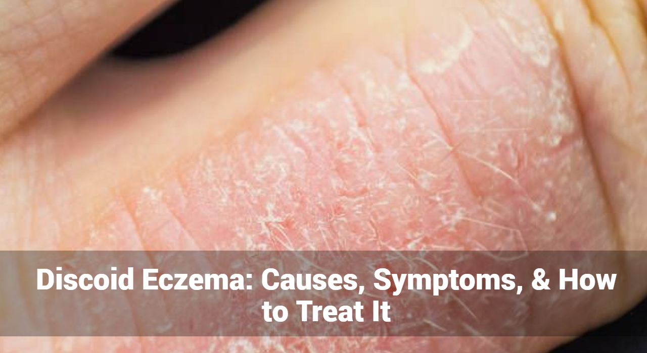 Eczéma discoïde : causes, symptômes et traitement