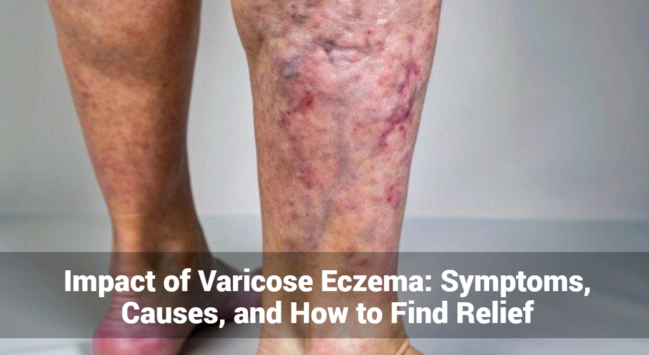 Impact of Varicose Eczema: Symptoms, Causes, and How to Find Relief