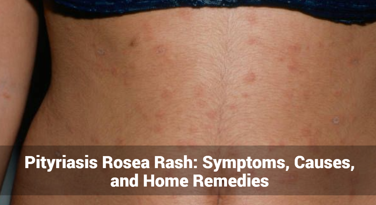 Pityriasis Rosea Rash: Symptoms, Causes, and Home Remedies