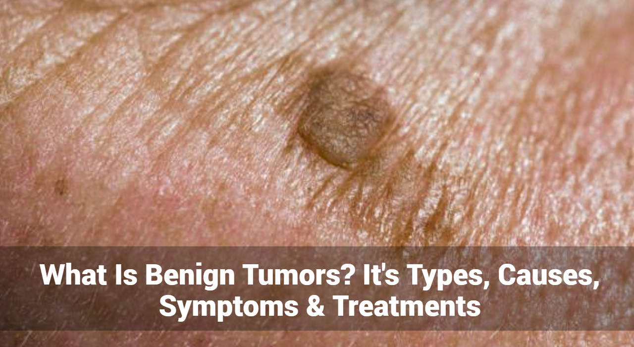 What Is Benign Tumors? It’s Types, Causes, Symptoms & Treatments