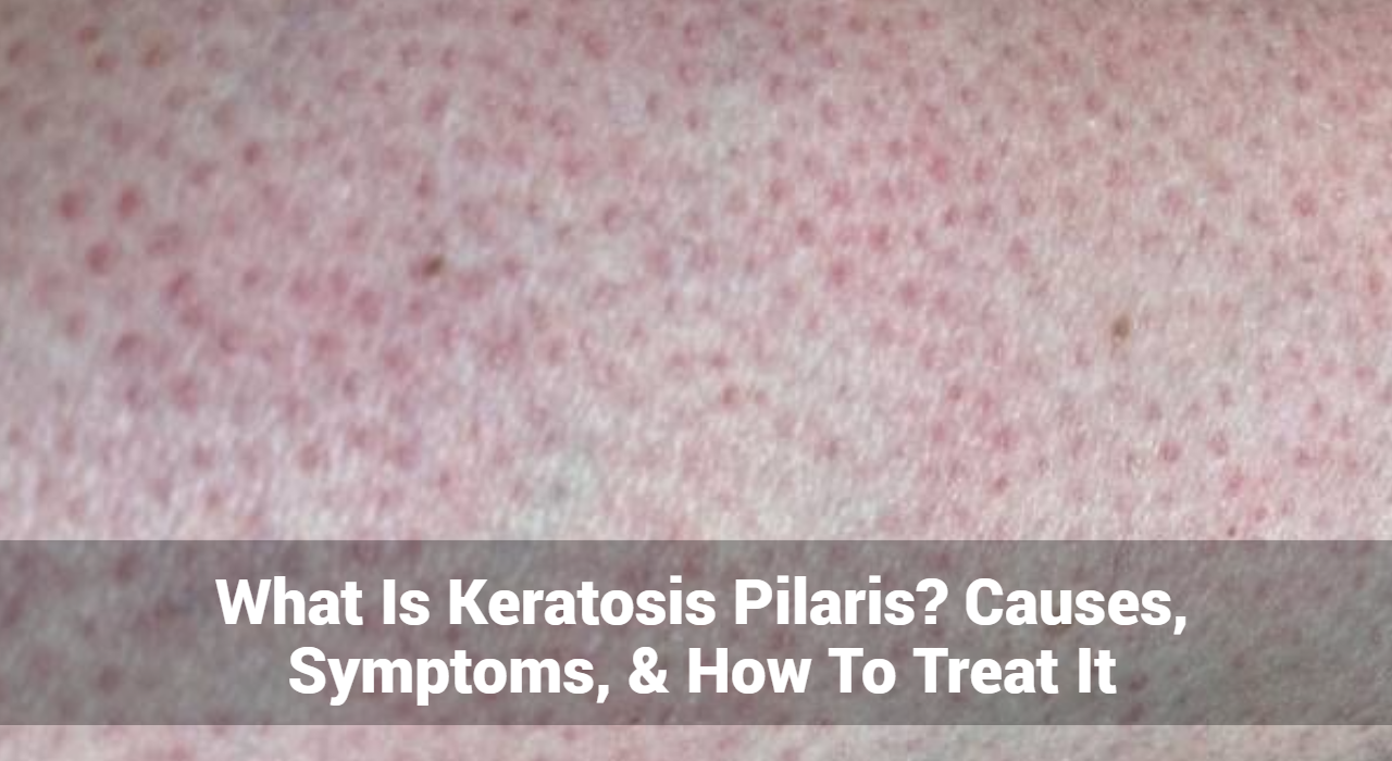 What Is Keratosis Pilaris? Causes, Symptoms, & Treatment