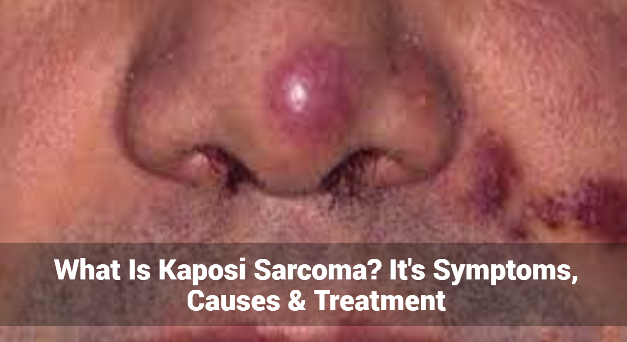 What Is Kaposi Sarcoma? It’s Symptoms, Causes & Treatment