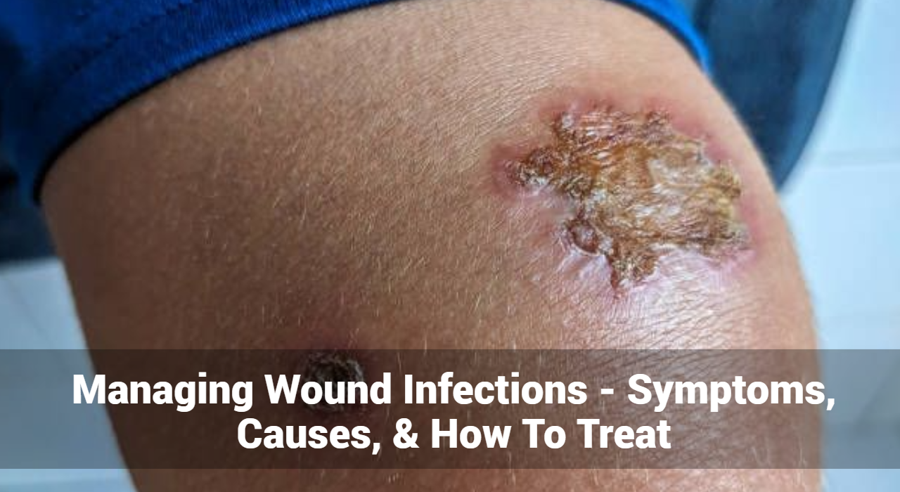 Managing Wound Infections – Symptoms, Causes, & How To Treat