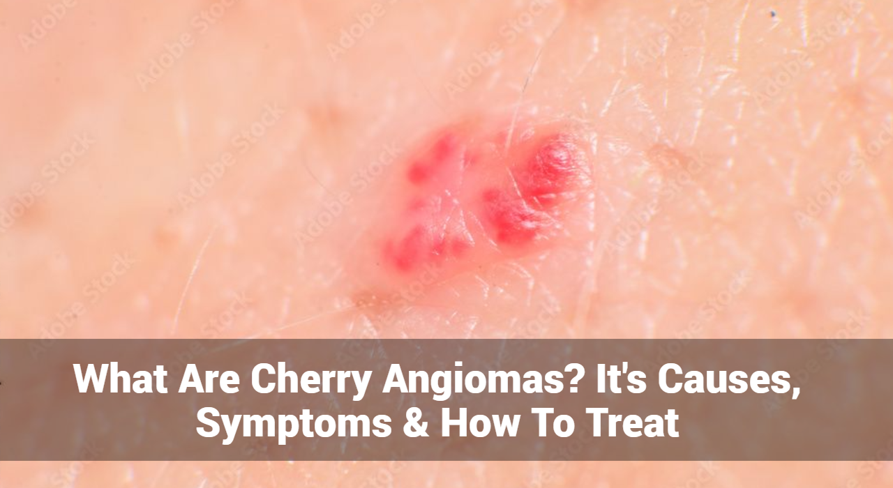 What Are Cherry Angiomas? It’s Causes, Symptoms & How To Treat | Eczemaless