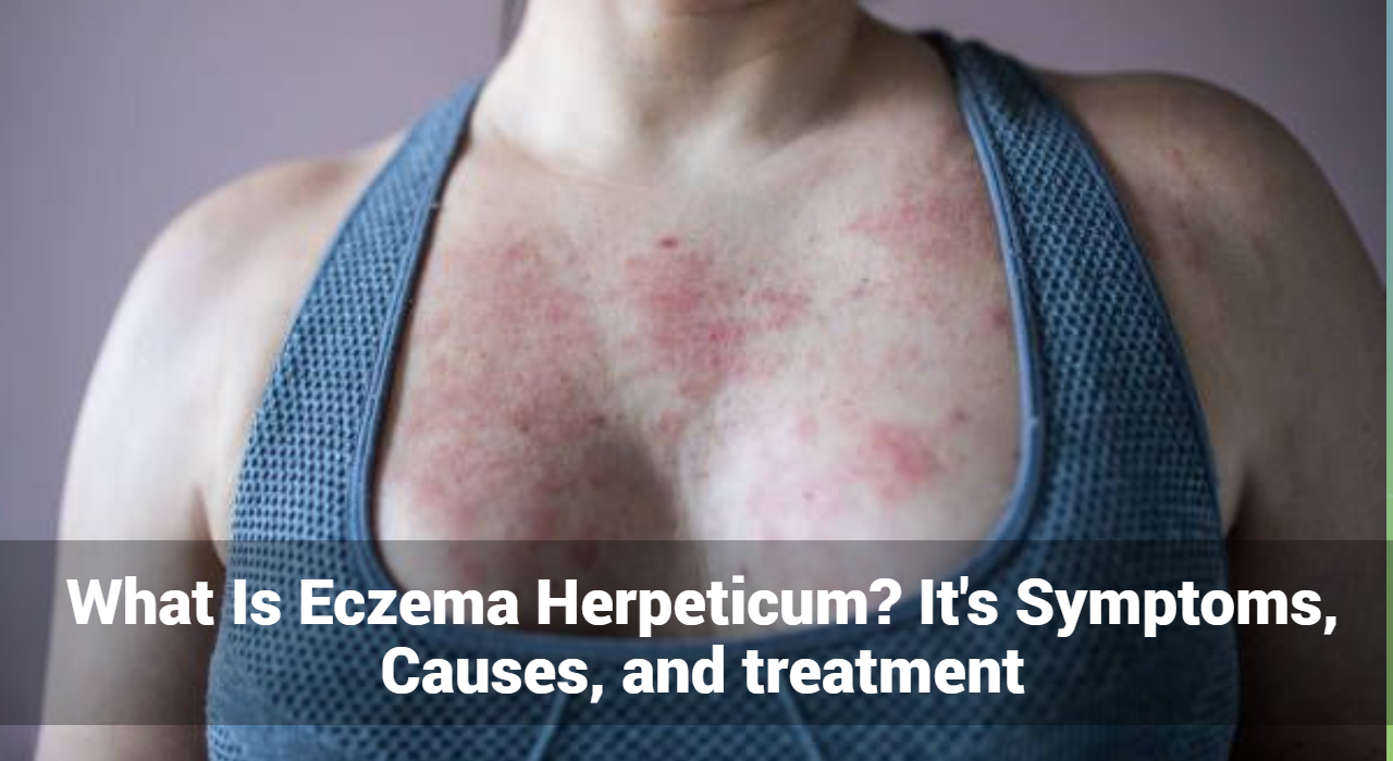 What Is Eczema Herpeticum? It’s Symptoms, Causes, and treatment