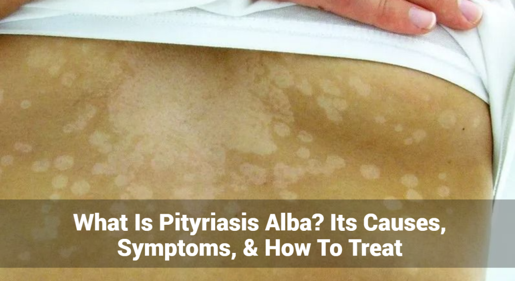 What Is Pityriasis Alba Its Causes Symptoms How To Treat Eczemaless What Is Pityriasis Alba Its Causes Symptoms How To Treat Eczemaless