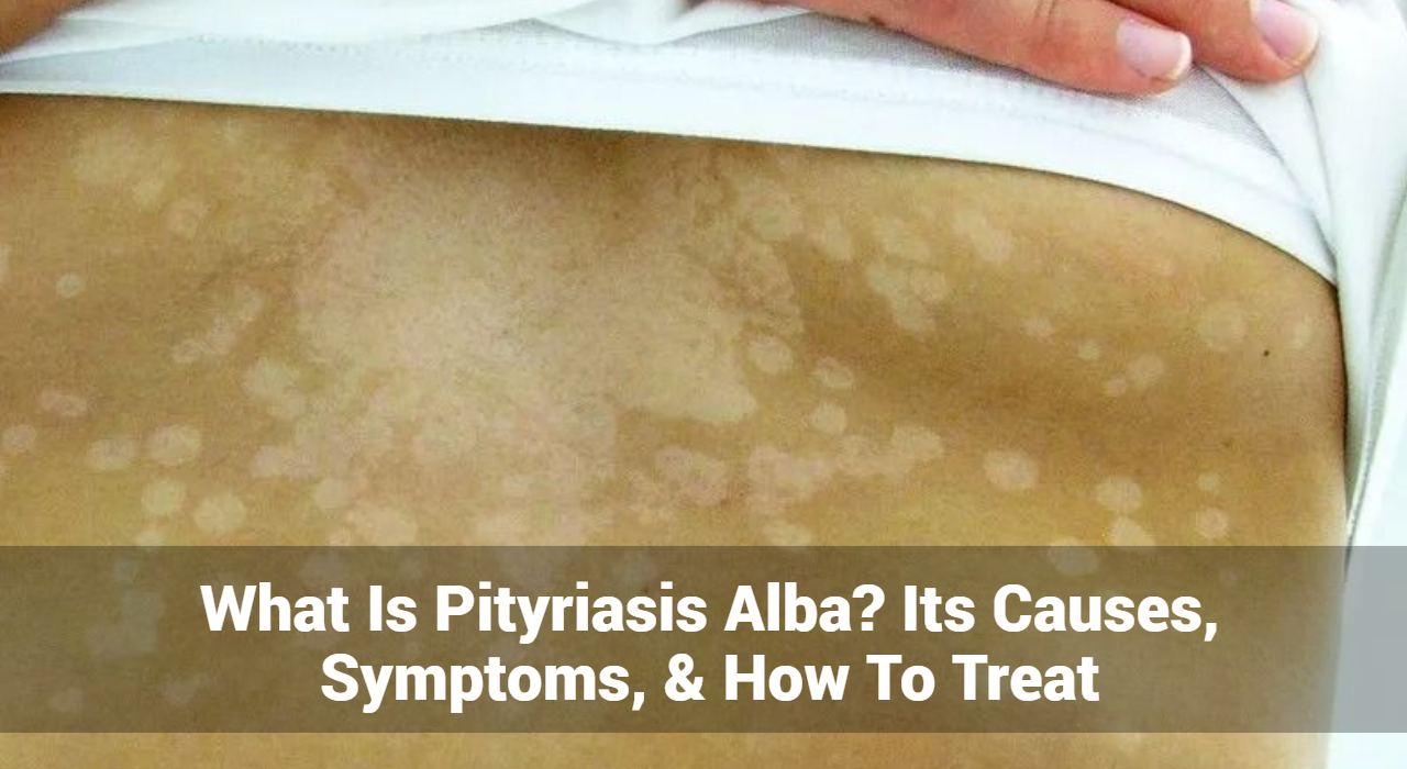 What Is Pityriasis Alba? Its Causes, Symptoms, & How To Treat